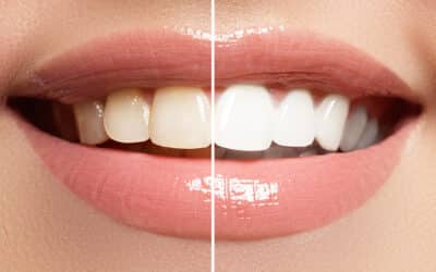 Weißere Zähne dank schwarzer Aktivkohle?