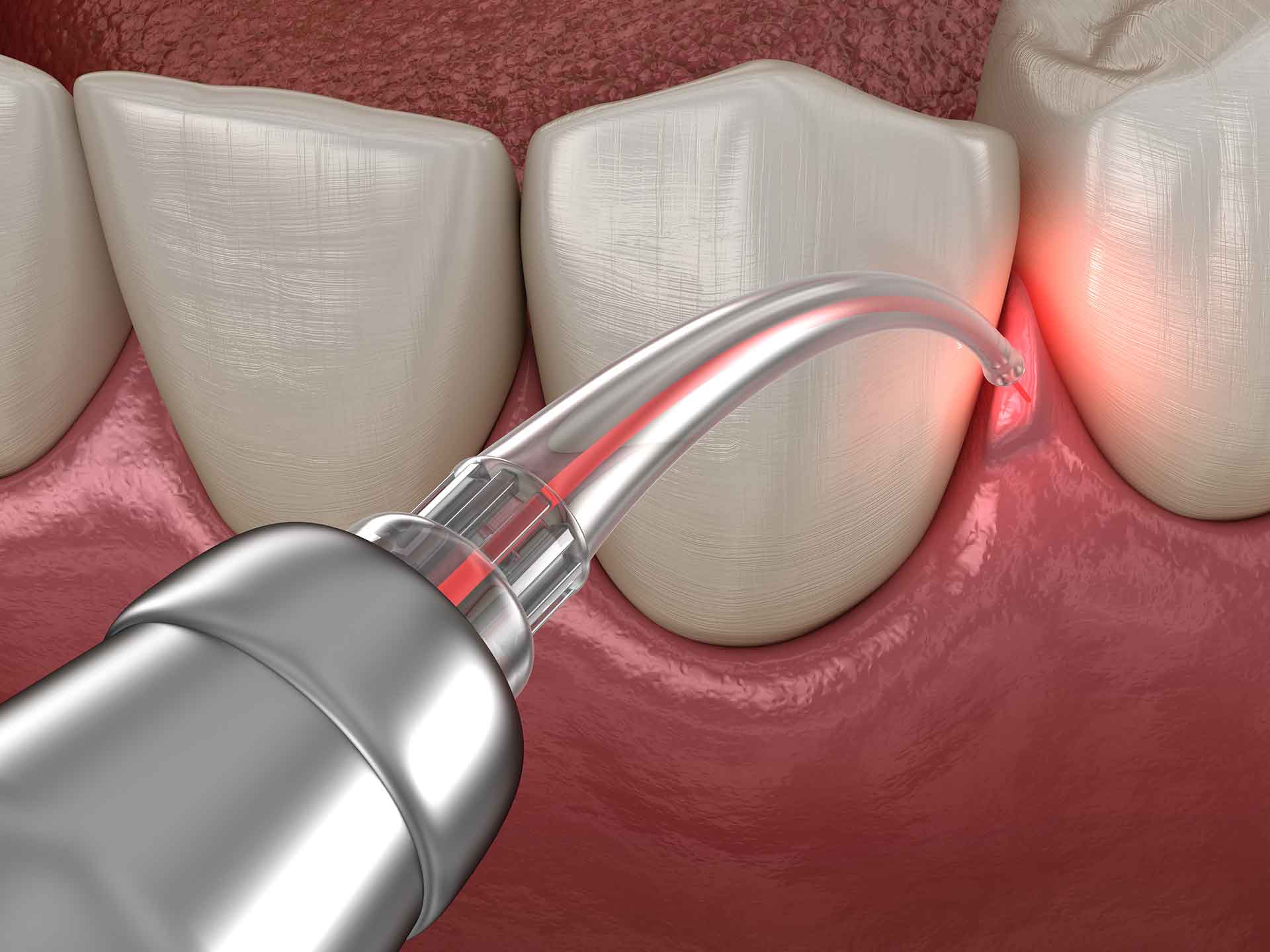 Parodontitis Behandlung mit Laser