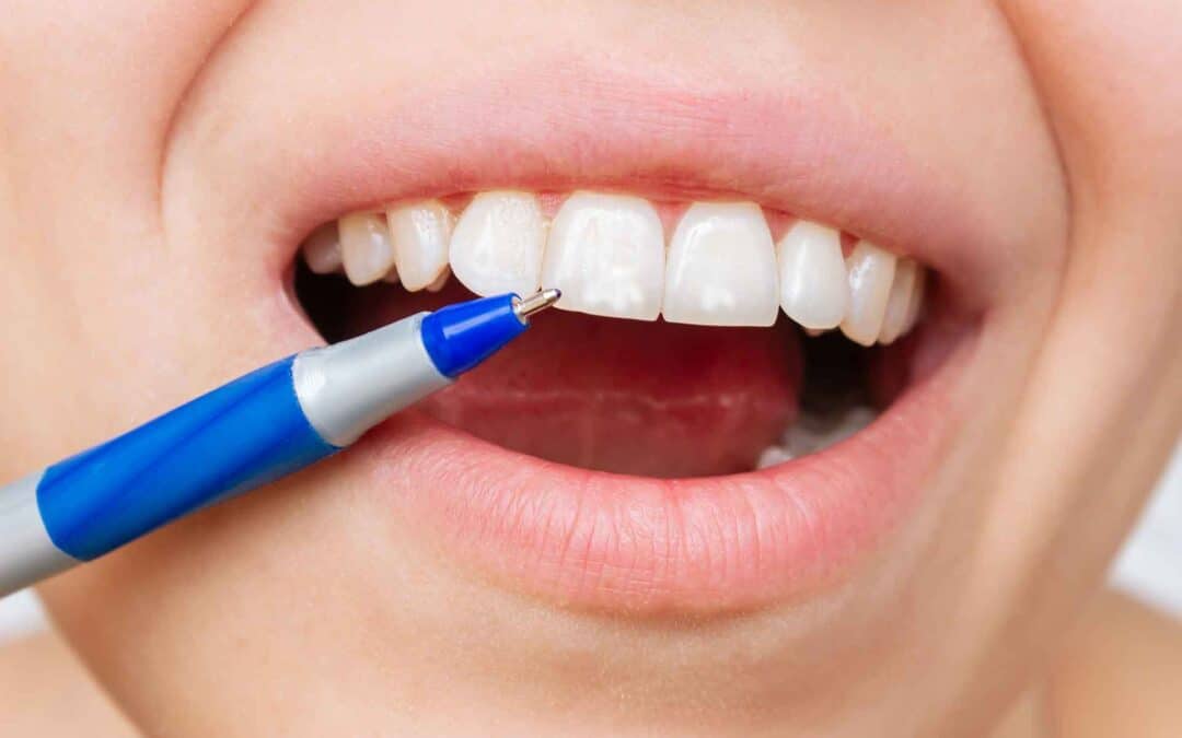 Weiße Flecken auf den Zähnen (White Spots)